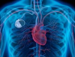 Watch-Sized Pacemaker: Fat-Burning Heart Switch