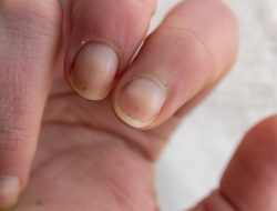 Nail changes reveal hidden health clues