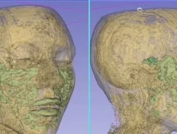 Eye-opening scan shows long-term risks of face fillers