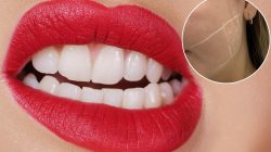 I suffered years of tooth-grinding headaches – until Botox at 24 saved me