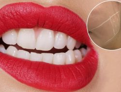 I suffered years of tooth-grinding headaches – until Botox at 24 saved me