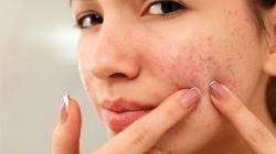 7 Alasan Kulit Kemerahan di Sekitar Hidung yang Wajib Kamu Ketahui