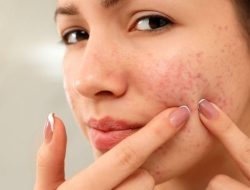 7 Alasan Kulit Kemerahan di Sekitar Hidung yang Wajib Kamu Ketahui