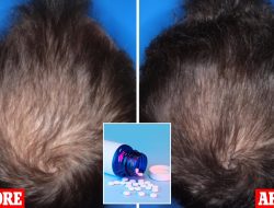 New drug boosts hair growth fourfold