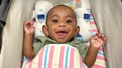 The race to save a joined twin