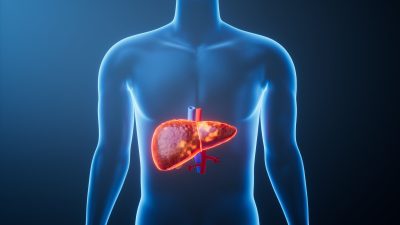 New Method Reveals Liver Disease Risk Years Before Symptoms Appear
