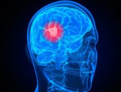 Why Is Glioblastoma So Hard To Treat?